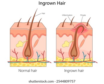 crescimento de cabelo normal e cabelo encravado causando inflamação, diferença em camadas de pele e diagrama de caminho de folículo piloso desenhado à mão ilustração vetorial esquemática. Ilustração educacional de ciências médicas