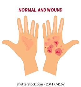 A normal hand compare with hand wit wounds, red and dark red on palm ,hand with scalp, brown and pink wound on palm