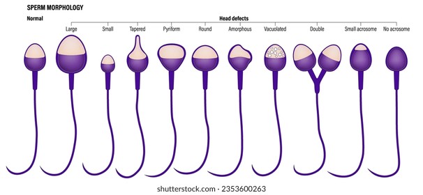 Esppermatozoo normal y de la cabeza. Vector de análisis de semen. Morfología espermática. Sistema reproductivo masculino