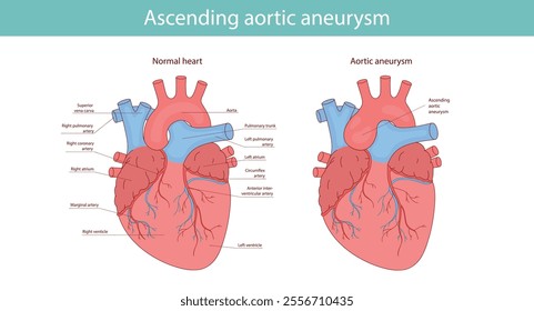 Normal heart and heart with aortic aneurysm. vector medical illustration.