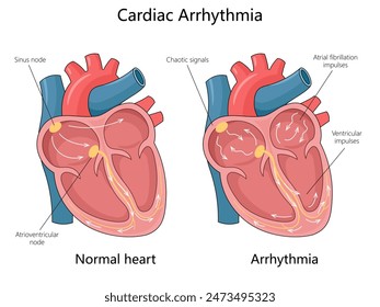 corazón normal con arritmia cardíaca, que muestra nódulo sinusal, señales caóticas y diagrama de fibrilación auricular con Ilustración vectorial esquemática dibujada a mano. Ilustración educativa de ciencias médicas