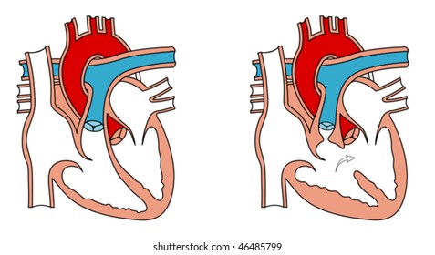 Normal heart and congenital birth defect