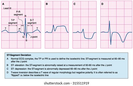 Normal Heart Ecg Trace Compared To Abnormal Traces -- St Elevation, St Depression And T-wave Depression.