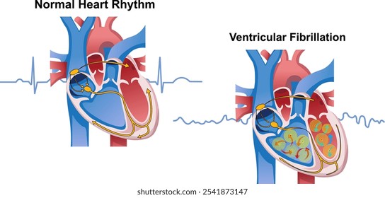 Normal heart rhythm vs Ventricular Fibrillation 