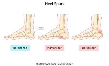 normal heel, plantar spur, and dorsal spur, showing calcaneus structure and areas affected by bone growth diagram hand drawn schematic vector illustration. Medical science educational illustration