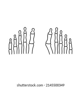 Normal Human Toes And Hallux Valgus Deformity Or Bunion Disease. Vector, Outline, Medical Concept.