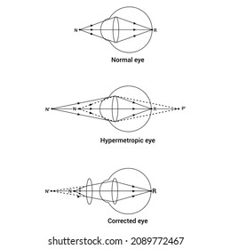 Normal hypermetropic and corrected eye