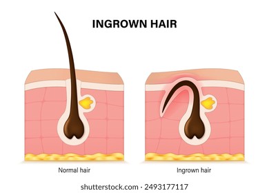 Normales und eingewachsenes Haar. Struktur der menschlichen Haarfollikel. Entzündung der Haut eingewachsener Haare.