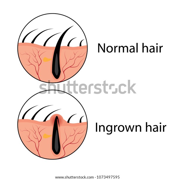 Normal Ingrown Hair Vector Illustration Skincare Stock Vector