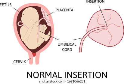 Normal insertion of umbilical cord. insertion site varies from the center of the fetal surface to the border of the placenta. risk factor. Medical vector illustration isolated on white.