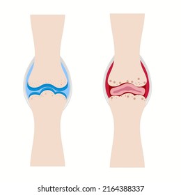 Normal Joint and Rheumatoid Arthritis