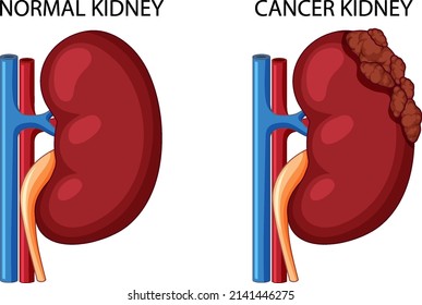 Normal Kidney And Cancer Kidney Illustration