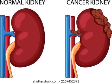 Normal Kidney And Cancer Kidney Illustration