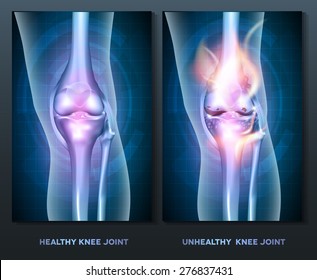 Normal knee and unhealthy abstract burning knee joint