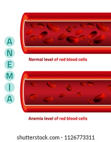Normal level of red blood cells in comparison with iron deficiency anemia level. Medical and healthcare concept. Vector illustration isolated on a white background.