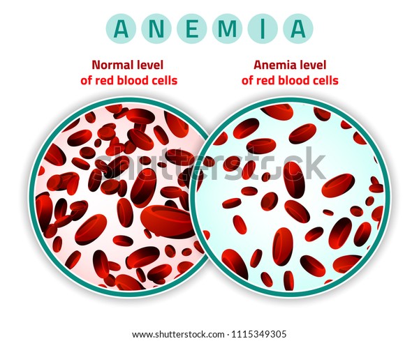 鉄欠乏性貧血に比べて赤血球のレベルは正常である 医療と医療のコンセプト 白い背景にベクターイラスト のベクター画像素材 ロイヤリティフリー