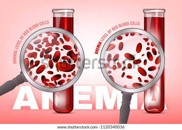 Normal level of red blood cells in comparison with iron deficiency anemia level. Medical and healthcare concept. Vector illustration isolated on a white background.