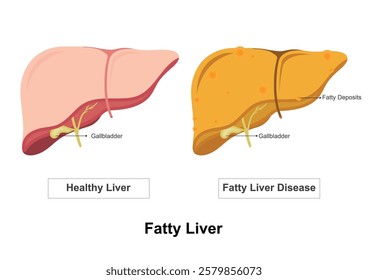 Normal Liver And Fatty Liver Disease isolatedon white .Fatty liver disease is a condition in which fat builds up in your liver. medical healthcare, vector illustration. 