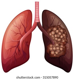 Normal Lung And Lung Cancer Illustration