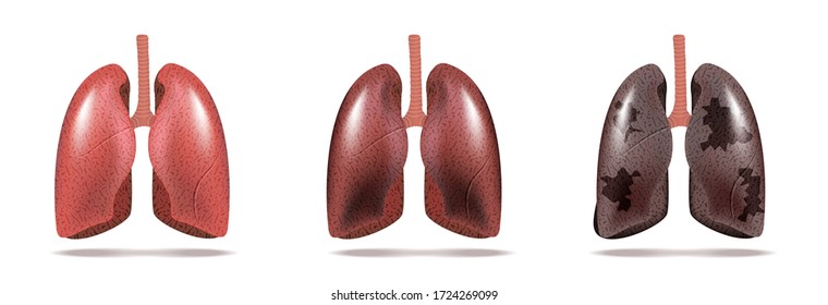 Ilustración normal del cáncer pulmonar y pulmonar. Vector.