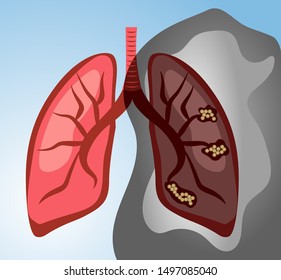 
Normal lung vs lung cancer (main causes of smoking)