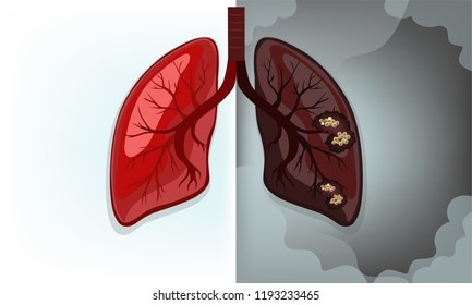 Normal Lung Vs Lung Cancer(main Causes Of Smoking)