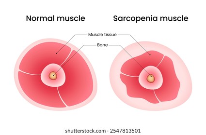 Músculo normal y músculo de sarcopenia