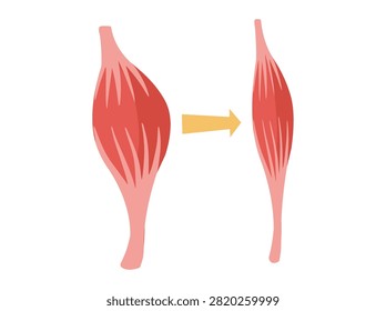 Normal Muscular and Dystrophy Atrophy