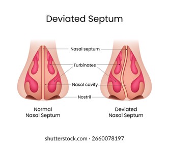 Septo Nasal Normal vs Septo Nasal Desviado