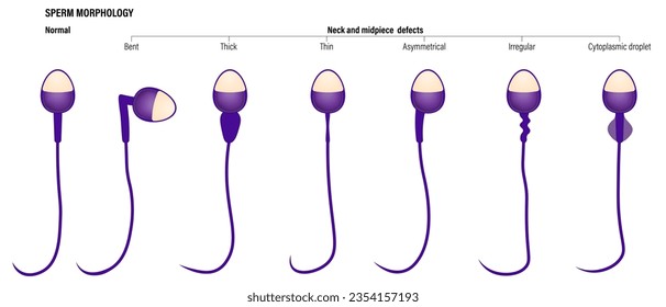 Normal con el espermatozoo de cuello y medio defectos. Vector de análisis de semen. Morfología espermática. Sistema reproductivo masculino.