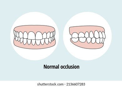 Normal Occlusion. Dental problem vector illustration. Dental care concept.