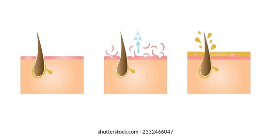 Normal, oily, and dry pores. Human Skin types and conditions on white background. Vector illustration.