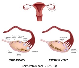 Normal ovarian cycle and Polycystic ovary syndrome, leading cause of infertility