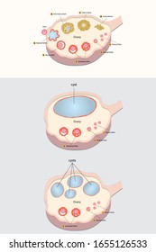 Normal Ovary And Ovarian Cysts Diagram