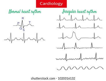 Normal and pathological ecg collection.Vector illustration.