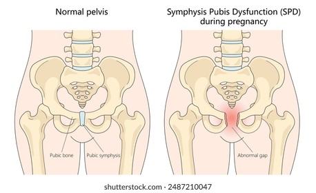 normal pelvis and affected by Symphysis Pubis Dysfunction during pregnancy, diagram hand drawn schematic vector illustration. Medical science educational illustration