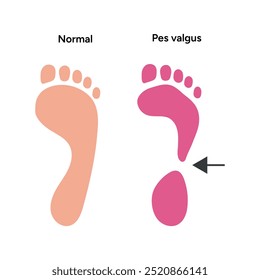 Normal and pes valgus foot	