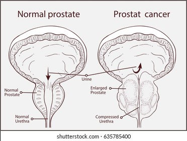 Normal Prostate Images, Stock Photos & Vectors | Shutterstock