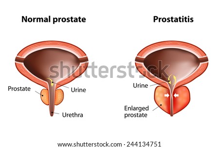 normal prostate and acute prostatitis. Medical illustration