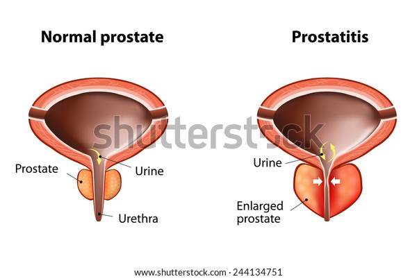 la toronja ayuda a la prostatitis aguda