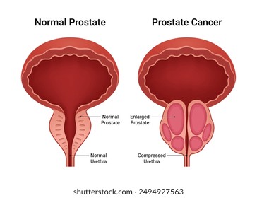 Normal Prostate and Prostate Cancer Inflammation