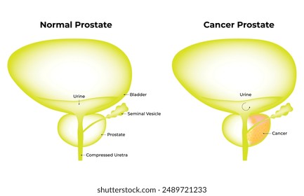 Normal Prostate Cancer Prostate Science Design Vector Illustration Diagram