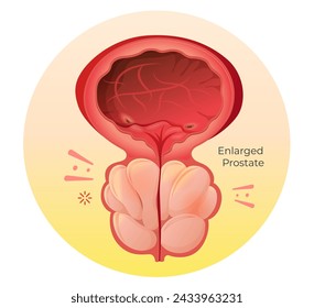 Normal Prostate and Enlarged Prostate Gland under Bladder - Stock Illustration as EPS 10 File