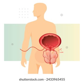 Normal Prostate and Enlarged Prostate Gland under Bladder - Stock Illustration as EPS 10 File