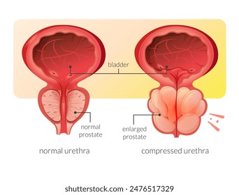 Normal Prostate and Enlarged Prostate Gland under Bladder - Stock Illustration as EPS 10 File