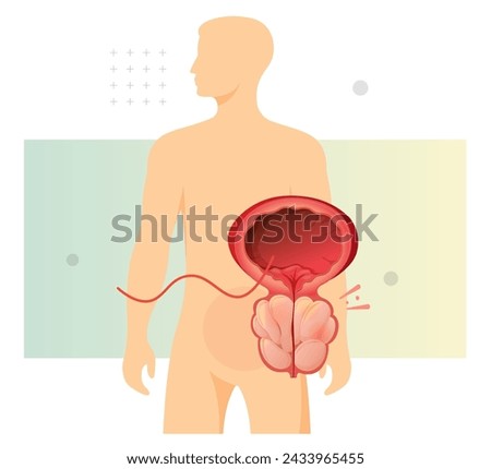 Normal Prostate and Enlarged Prostate Gland under Bladder - Stock Illustration as EPS 10 File