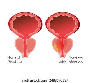 Normal Prostate and Prostate Gland with Infection - Stock Illustration as EPS 10 File