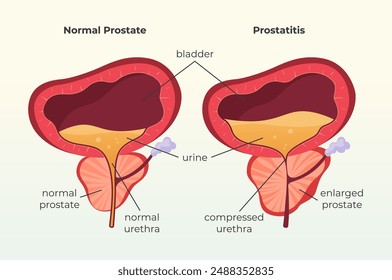 Glándula prostática normal bajo la vejiga vs prostatitis - Ilustración de stock como archivo EPS 10