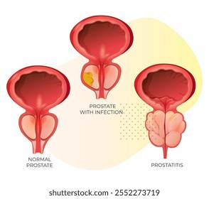 Normal Prostate,  Prostate with Infection and Enlarged Prostate Gland under Bladder - Stock Illustration as EPS 10 File