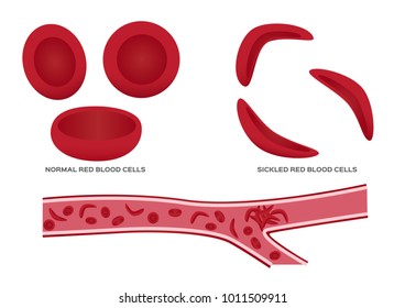 Normal Red Blood Cell And Sickle Cell Vector